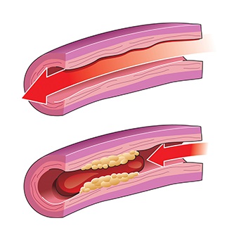  . Normal blood flow through healthy artery and blocked blood flow in artery with yellow plaque and red blood clot.
